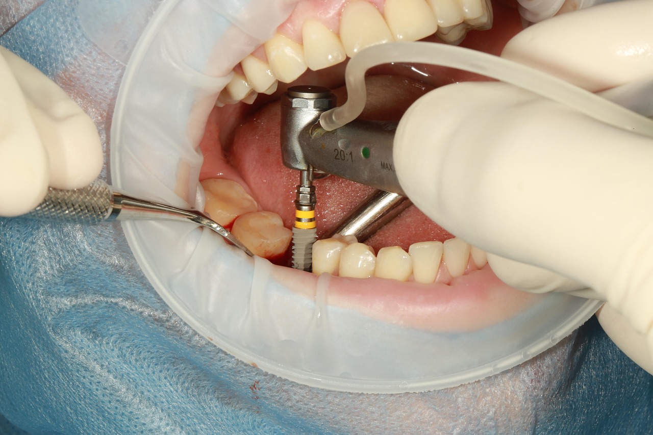 En esta fotografía, podemos ver a un profesional realizando un implante dental a un paciente